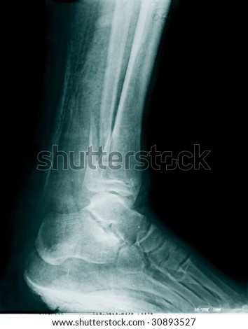 Real x-ray picture of the broken foot