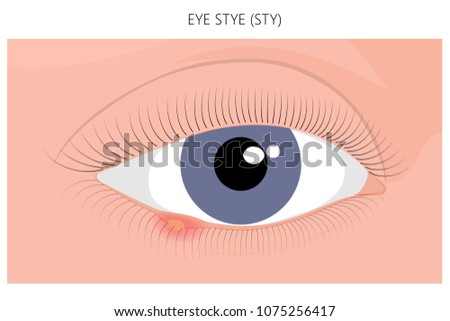 Vector illustration. Eye Stye (Sty) problem. Close up view. For advertising, medicinal publications. EPS 10