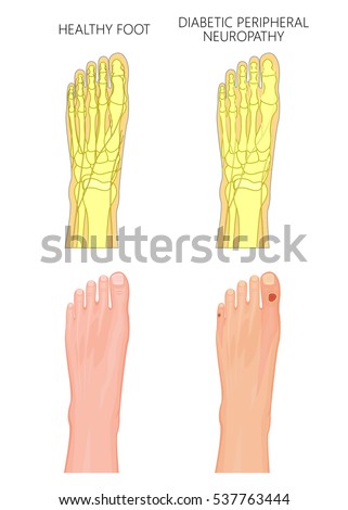 Illustration of Diabetic Peripheral Neuropathy. Healthy foot and foot with damaged nerves and ulcers on the toes. Used: transparency, gradient, blend mode.