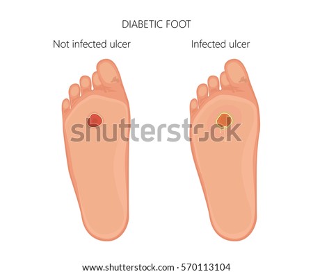 Vector illustration. Diabetic foot with not infected ulcer and diabetic foot with infected ulcer. Bottom view, sole. EPS 10. Blend mode and transparency was used.