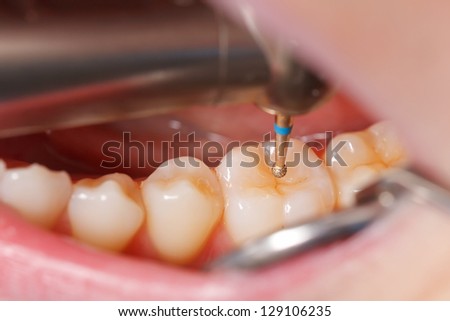 The dentist cleans the tooth with drill