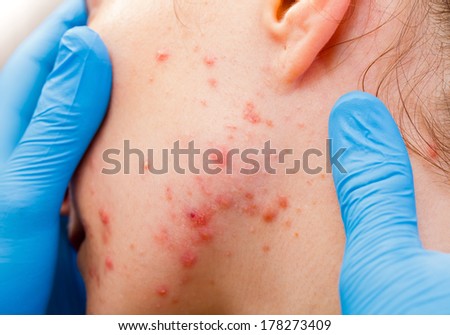 Acne because the disorders of sebaceous glands productions