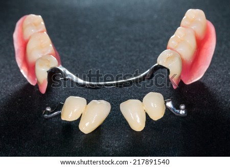 Closeup of dental skeletal prosthesis with porcelain crowns