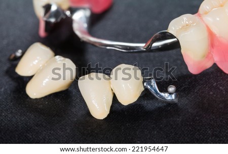 Closeup of dental skeletal prosthesis with porcelain crowns