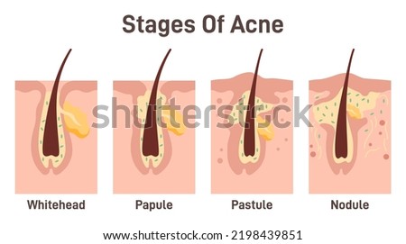 Acne development stages. Inflamed skin pimples. Plugged hair follicles, oil and dead skin cell comedo lead to bacteria grow. Flat vector illustration