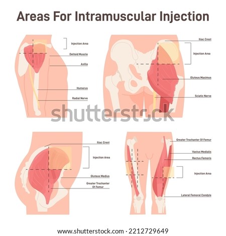 Intramuscular injection areas. Guide to injecting medication into muscle. Sites with large, easy-to-locate muscles and little fatty tissue, upper arm, thigh, hip and buttock. Flat vector illustration