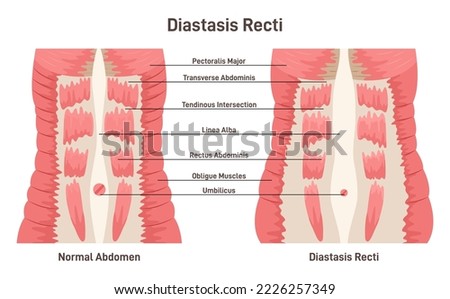 Diastasis rect. Abdominal muscles separation. Human torso muscles anatomy. Postpartum medical condition. Flat vector illustration