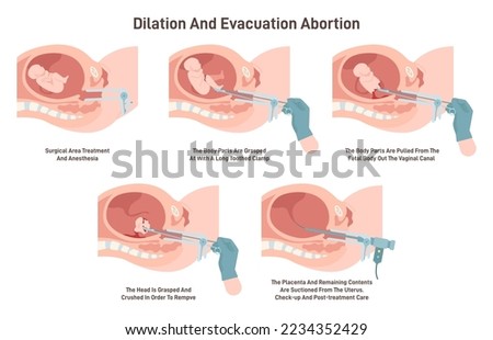 Dilation and evacuation abortion. Gynecology surgery. Embryo or fetus removing from uterus. Pregnancy termination. Flat vector illustration