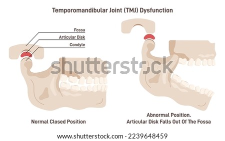Temporomandibular joint disorder or TMJ. Condition affecting the jaw joints and surrounding muscles and ligaments. Lower jaw bone joint dislocation. Flat vector illustration