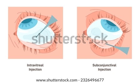 Eyes injection types. Intravitreal and subconjunctival injection. Administration of medicine into the eyeball or eyelid. Retinal diseases treatment. Flat vector illustration