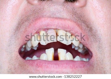 Rotten and crooked teeth of men. Crooked teeth can be sign of running periodontal.