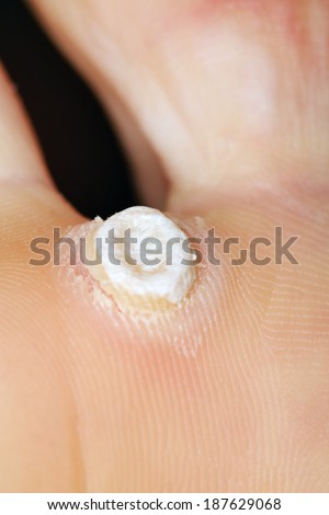 Falling off wart on sole of female feet. Wart - benign skin growths of viral etiology