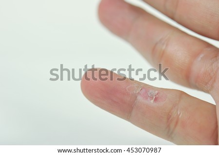 Treatment Wart On Finger By Salicylic Acid. Stock Photo 453070987 ...