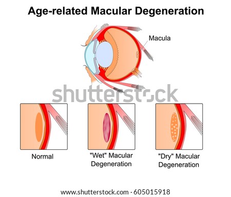 Age-related macular degeneration.Eye vision disorder.Diagram of the eye