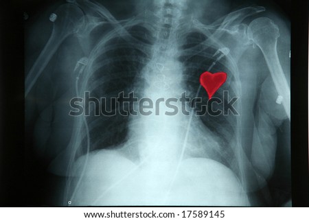 A X-Ray Shows Before A Broken Heart Stock Photo 17589145 : Shutterstock
