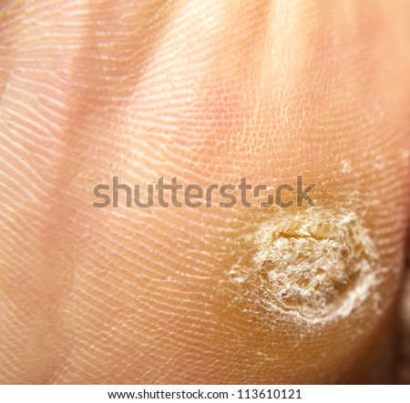 Callus And Hyperkeratosis On Feet, Closeup, Dried Skin Stock Photo ...