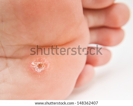 Person with callus located under foot, close to toes towards white