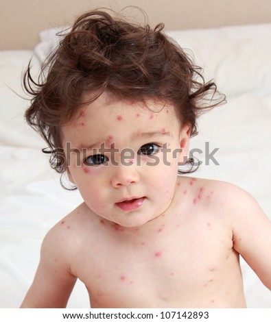 Baby with chicken pox rash
