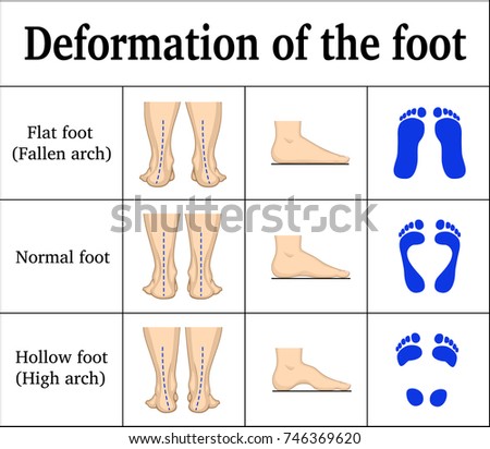 Illustration of the deformation of the foot - flat feet and a hollow foot. There are footprints, the form of the foot on the side and behind