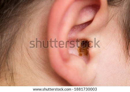 Earwax in the dirty ear of a child. Hole ear of human, wax on hair and skin of ear.