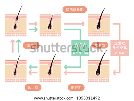 Comparative illustration of normal hair cycle and AGA ( androgenetic alopecia)/ japanese. Seichouki (anagen) , Taikouki (catagen),kyuushiki (teloen) etc.