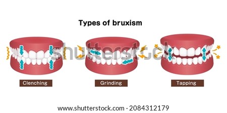Types of bruxism (teeth grinding) vector illustration