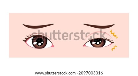 Causes of myokymia (eyelid twitch or tic) vector illustration