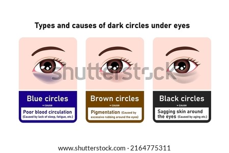 Types and causes of dark circles under eyes. Vector illustration
