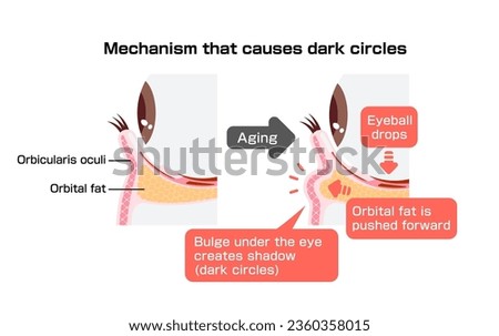 Mechanism of dark circles caused by aging. Vector illustration of cross section.