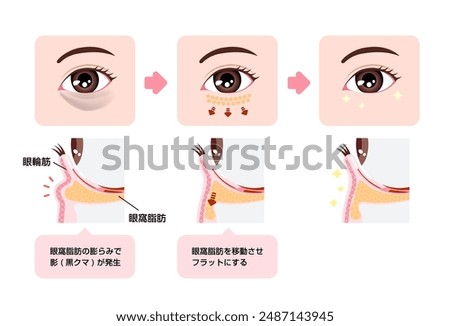 How to remove dark circles under the eyes with Lower blepharoplasty (Transconjunctival blepharoplasty). . Translation: Orbicularis oculi, Orbital fat, Shadow (dark circle) 
appears due to orbital fat.