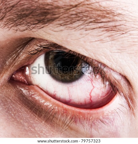Medicine healthcare blood capillary human eye pain