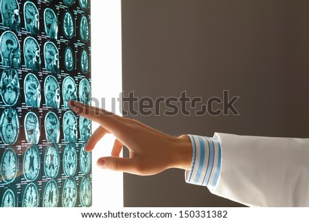 Close-up image of doctor\'s hand pointing at x-ray results