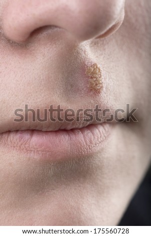 Close up of a  common cold sore virus herpes simplex