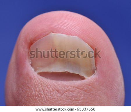 Close up image of left foot toe nail suffering from fungus infection - a series of FUNGI NAIL images.