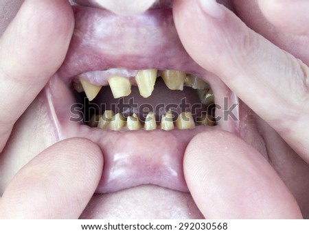 Teeth of the elderly woman are processed and cut for installation of ceramic artificial denture. Soft art focus