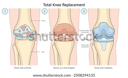 total knee replacement surgery, progression from arthritis-damaged knee to bone shaping and implant placement diagram hand drawn schematic vector illustration. Medical science educational illustration