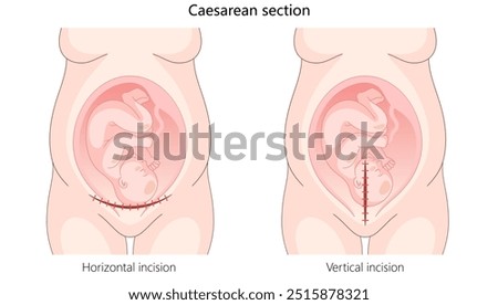 caesarean section with horizontal and vertical incisions for delivering a baby through surgical methods hand drawn schematic vector illustration. Medical science educational illustration