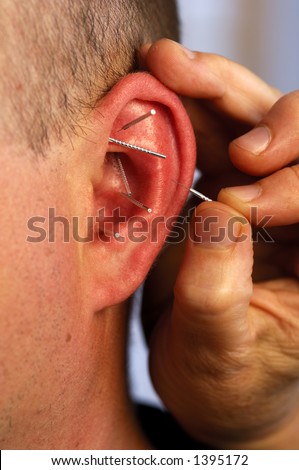 Acupuncture in the ear
