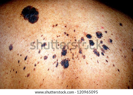 Skin moles on the back of a man.