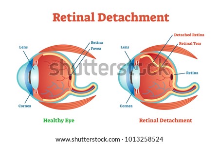 Retinal Detachment vector illustration diagram, anatomical scheme. Medicinal educational information. 