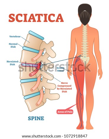 Sciatica medical health care vector illustration scheme with lower spine and sciatic nerve pain in leg. Backbone diagram with vertebrae, disks and nerves. Full woman patient body from back.