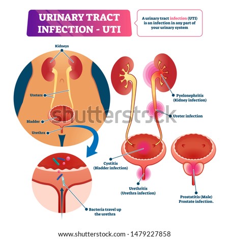 Urinary tract infection or UTI vector illustration. Labeled medical disease scheme with inner organs structure diagram. Educational bladder system illness and problem list. Kidney disorder infographic