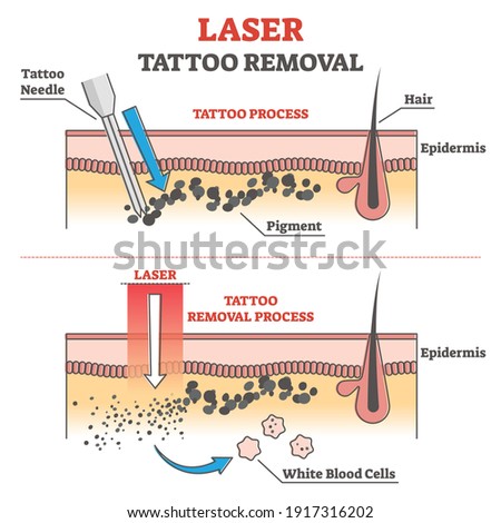 Laser tattoo removal process labeled educational explanation outline concept. Anatomical epidermis side view with pigment under skin vector illustration. Professional cosmetic procedure to erase ink.