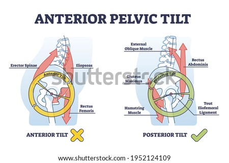 Anterior pelvic tilt model compared with posterior labeled outline diagram. Educational scheme with skeletal bone location and movement angle vector illustration. Anatomical right posture explanation. Stock foto © 