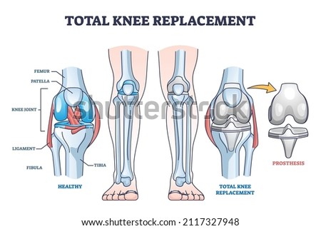 Total knee replacement surgery and prosthesis operation outline diagram. Labeled educational medical procedure description with healthy orthopedic anatomical bone structure scheme vector illustration.