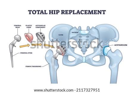 Total hip replacement surgery with anatomical acetabular prosthesis outline diagram. Labeled educational medical operation process description with new artificial bone structure vector illustration.