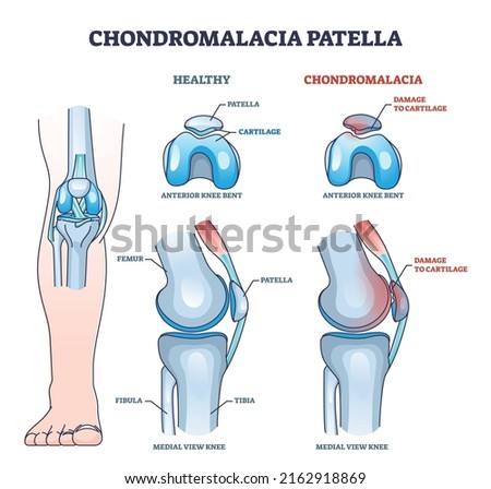 Chondromalacia patella knee breakdown compared with healthy outline diagram. Labeled educational kneecap tissue damage with cartilage problem and anatomical leg joint structure vector illustration. Сток-фото © 