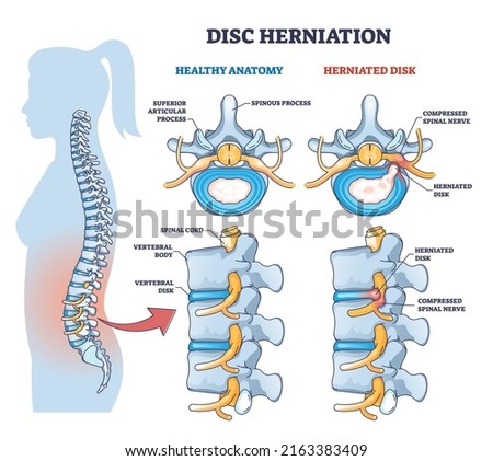 Disc herniation or spine nerve compression vs healthy anatomy outline diagram. Labeled educational scheme with superior articular process and herniated disk vector illustration. Vertebral body trauma.