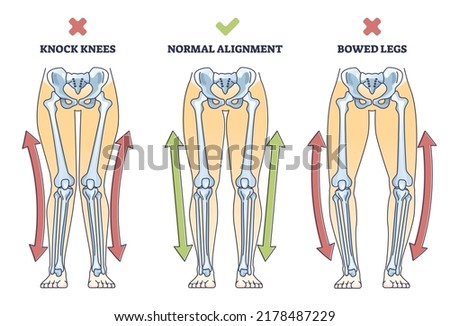 Bowed legs syndrome with normal and knock legs comparison outline diagram. Labeled educational physical defect with outward bending and knees does not touch vector illustration. Anatomical explanation Foto d'archivio © 
