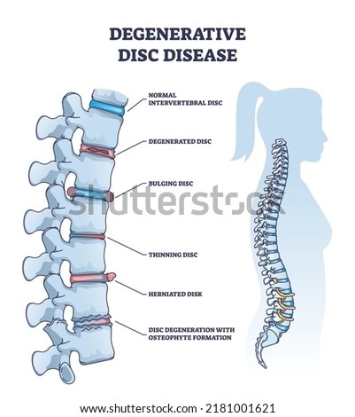 Degenerative disc disease with spine and vertebra trauma outline diagram. Labeled educational normal intervertebral, degenerated, bulging, thinning and herniated problem example vector illustration.